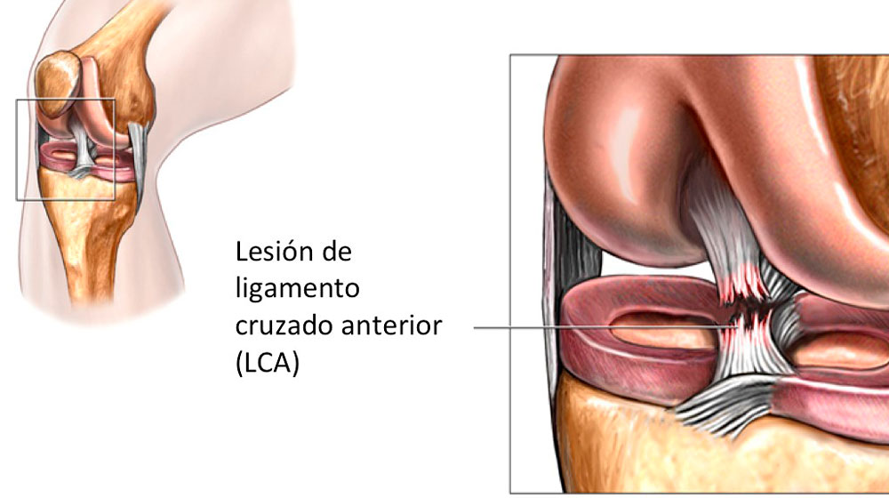 LCA - rotura ligamento cruzado anterior